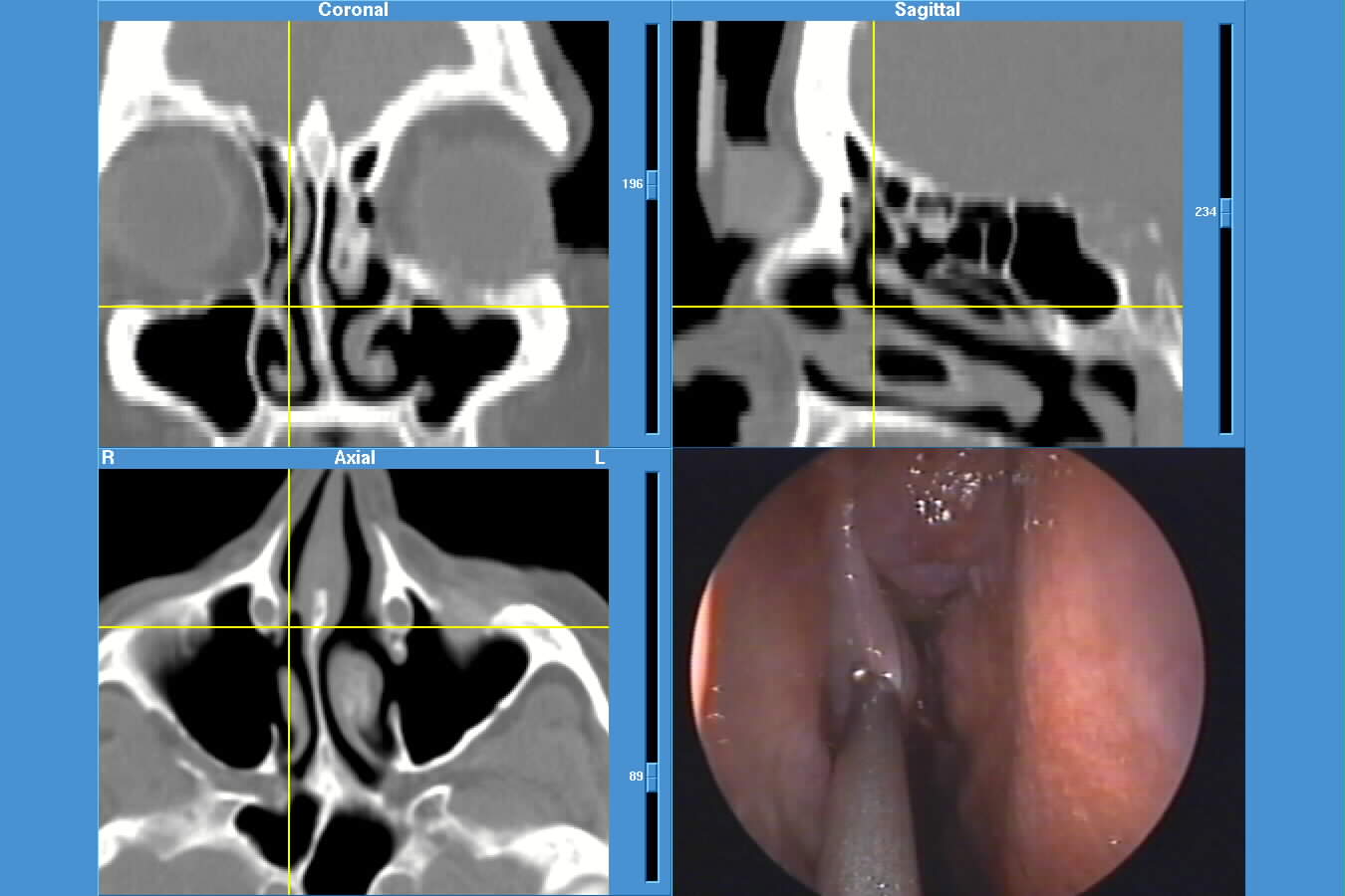 JPEG image of Instatrak surgery