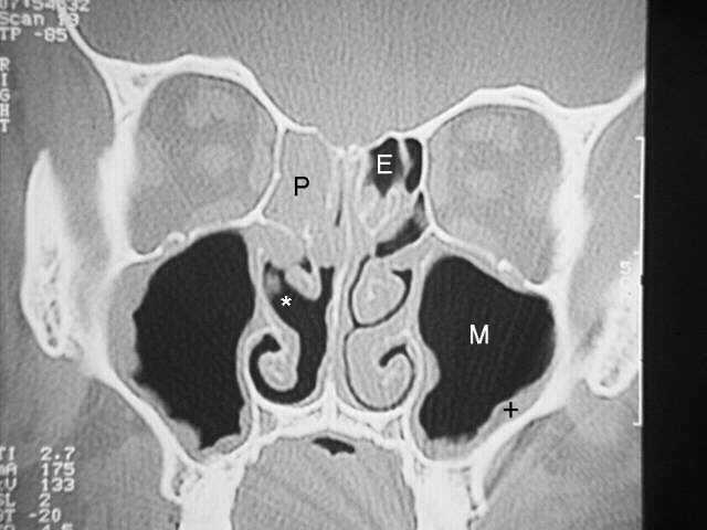 nose ct scan