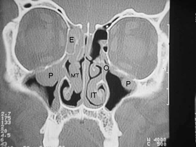 Acute Sphenoid Sinusitis